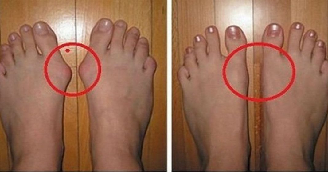 Easily Remove Uric Acid Crystals Remove Uric Acid Crystals