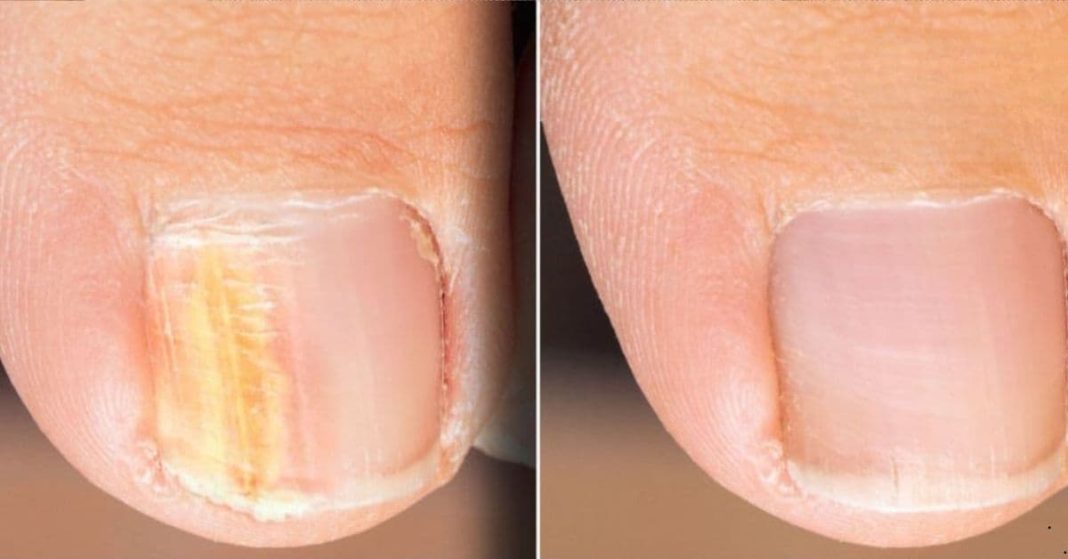 Iodine for nail fungus Iodine for nail fungus