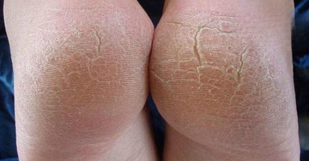 cracked heels' treatment