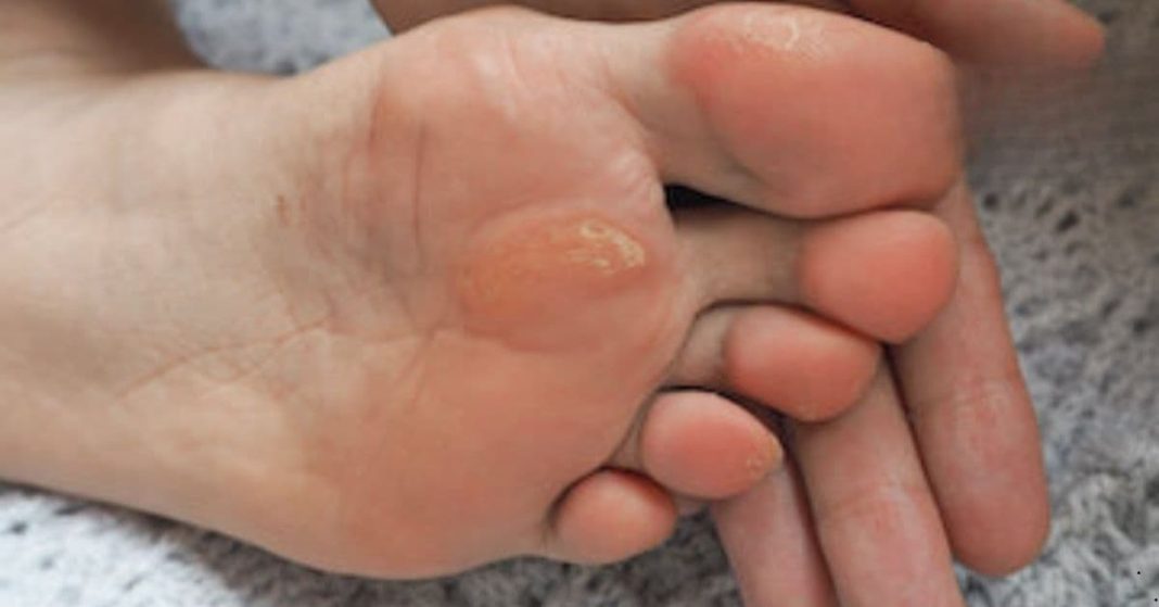 effective method for calluses effective method for calluses