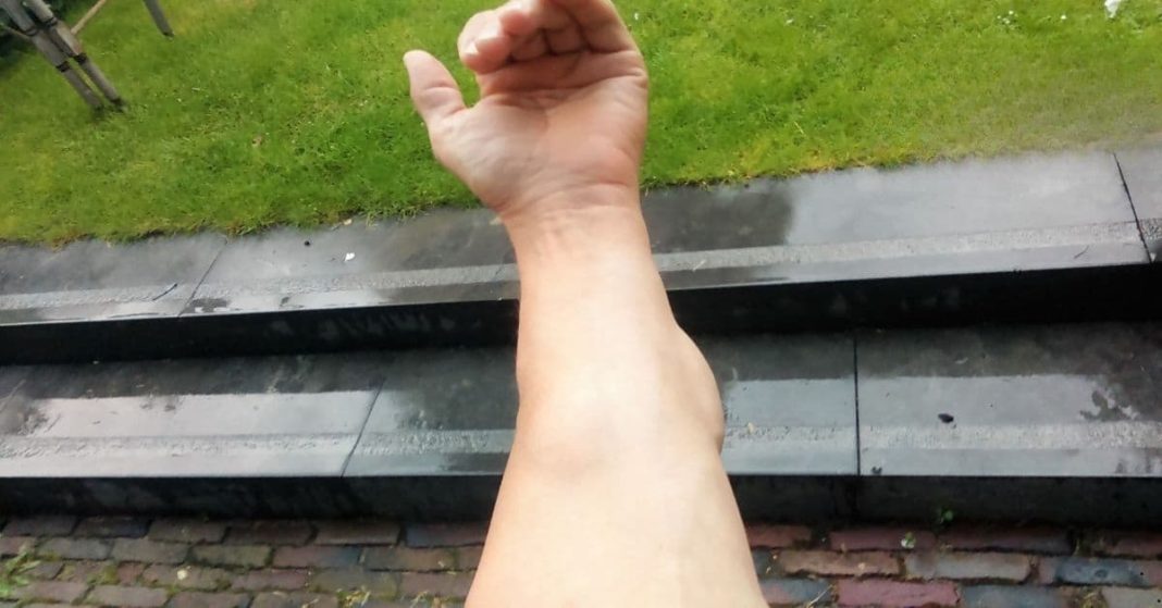 Lipoma Remedy Lipoma Remedy