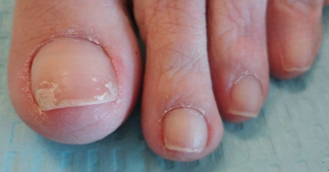 Nail fungus Nail fungus