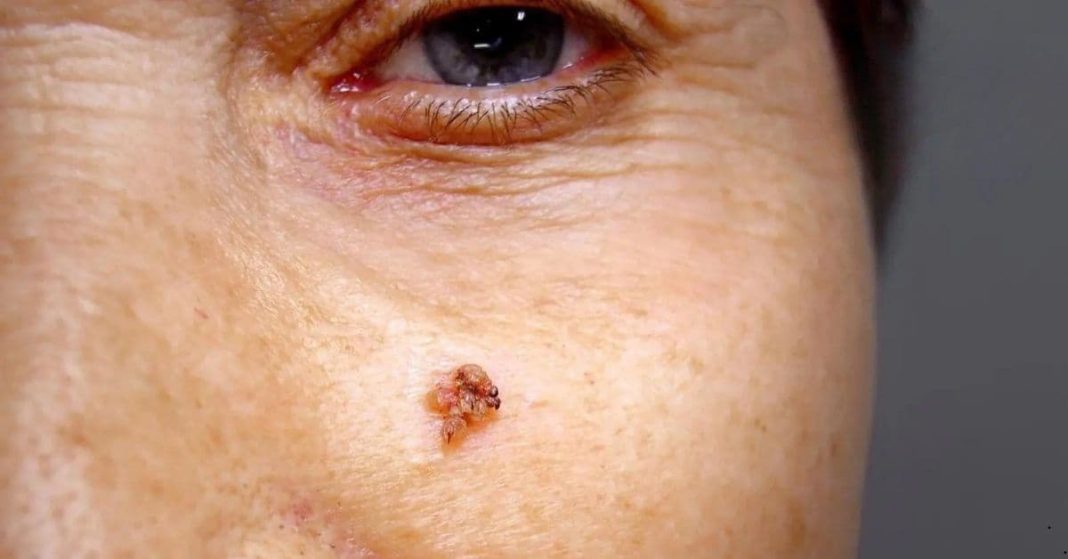 warts, rashes, and age spots