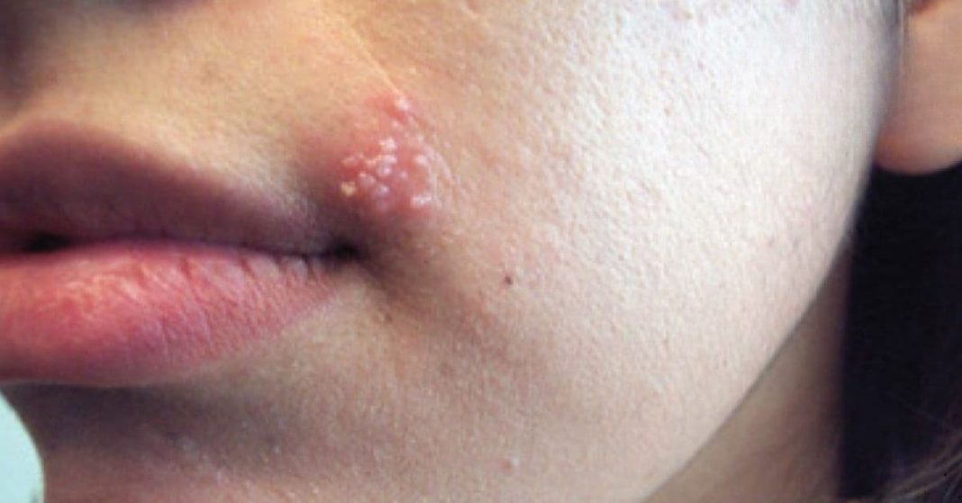 get rid of herpes quickly get rid of herpes quickly
