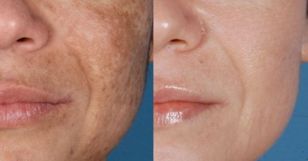 wrinkles, age spots, and dark circles will disappear