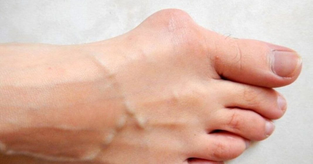 Eliminating Uric Acid from the Body