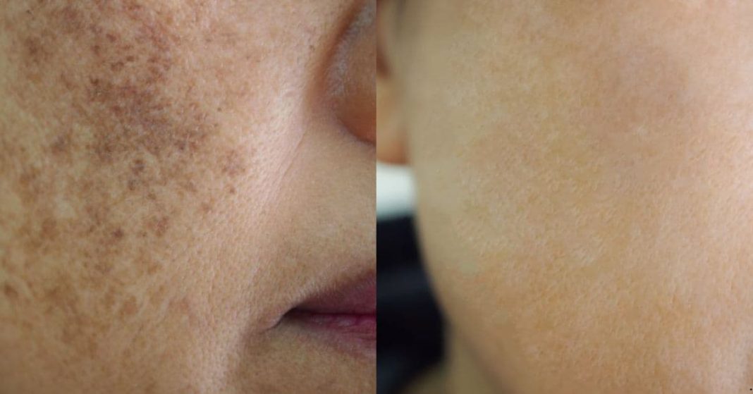 Remove age spots